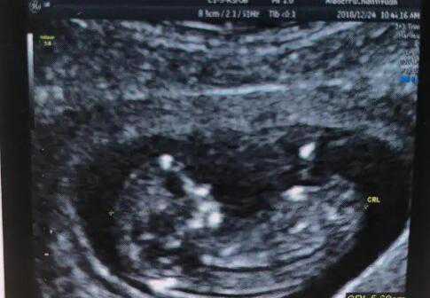 武汉捐卵子 2022武汉不孕不育医院排名 ‘生男孩nt图’