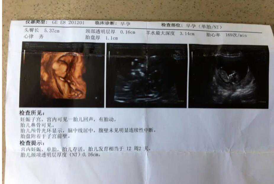 武汉代怀生男孩正规吗 武汉试管婴儿费用 ‘b超单孕囊看男女图片’